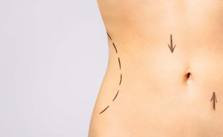 Leia mais sobre o artigo O que é Abdominoplastia?