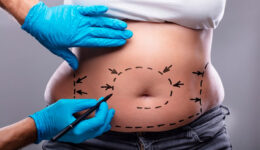 Lipoescultura: o que é, como é feita e recuperação