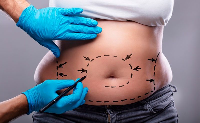No momento, você está visualizando Lipoescultura: o que é, como é feita e recuperação