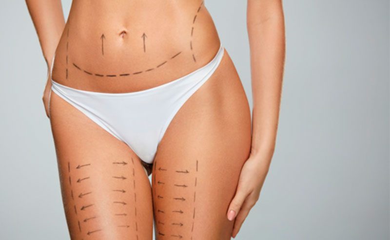 No momento, você está visualizando Cirurgia plástica pós-bariátrica: saiba quando fazer e quais são as recomendações médicas