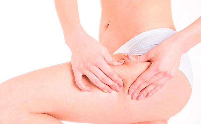 No momento, você está visualizando Celulite, obesidade, linfedema ou lipedema? A importância do diagnóstico diferencial