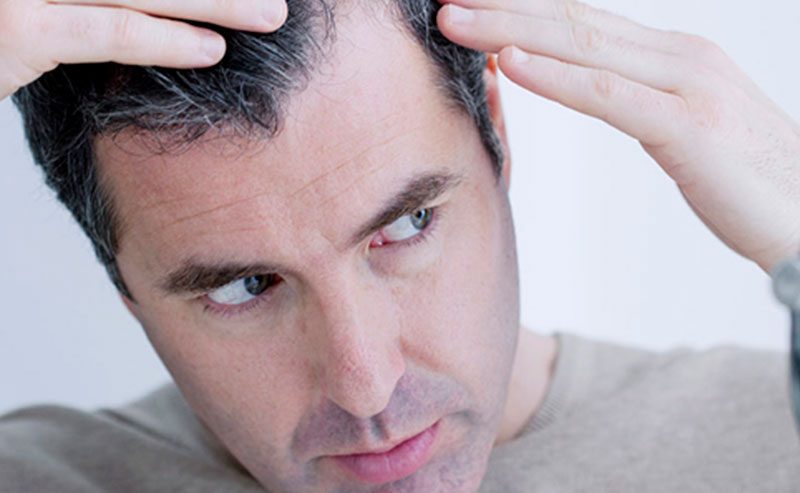 No momento, você está visualizando Calvície (Alopecia, Queda de Cabelo)