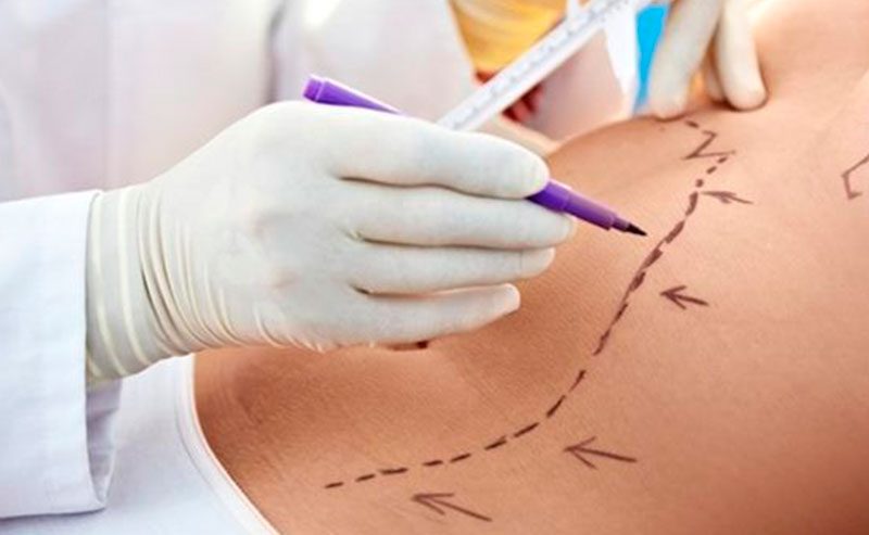 No momento, você está visualizando Diferenças entre a lipoaspiração cosmética e a cirurgia de lipedema