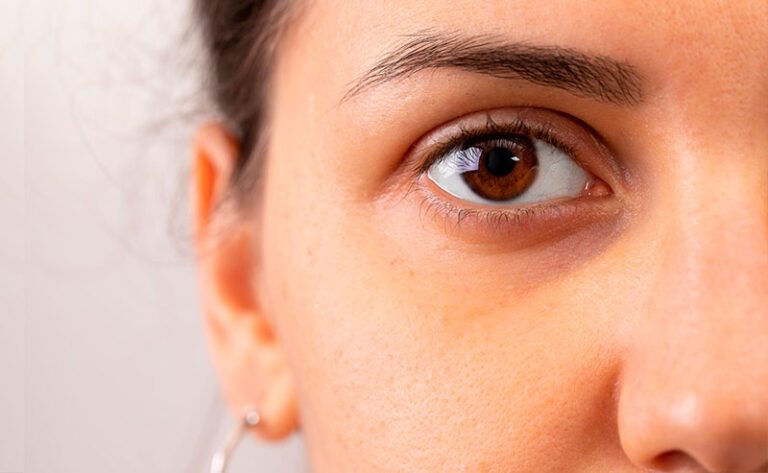 Leia mais sobre o artigo Olheiras: Como eliminar olheiras profundas